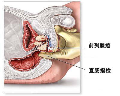 慢性前列腺炎的症状图片